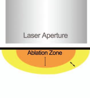 Unique Double Peel Ablative & Non-Ablative Benefits Depending on the energy fluence selected, both precise ablative removal of the outer layers of the epidermis and underlying non-ablative