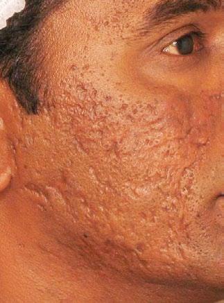 Acne Scars After 6 Tx Courtesy of: Maria Angelo-Khattar, PhD,