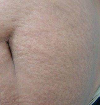 Stretch Marks After Courtesy of: Maria