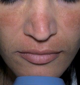 Melasma After 1 Tx Courtesy of: Michael Shohat, MD,
