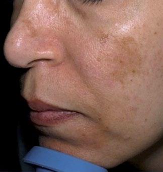 Melasma After 1 Tx Courtesy of: Michael Shohat, MD, Dermatologist Aesthetic Laser Clinic, Tel Aviv,
