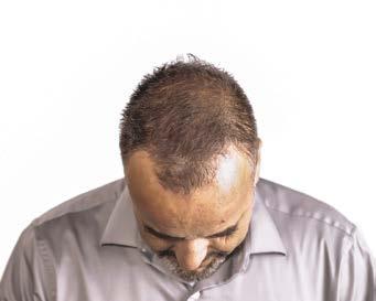 3 If you are noticing that your hairline is receding, thinning, or you are seeing more hair than usual in the shower drain, you may be wondering about permanent options to treat your hair loss.