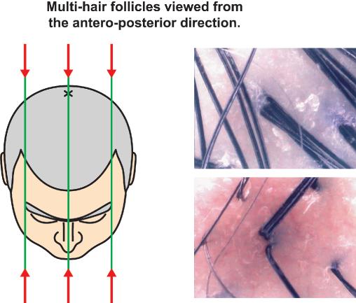 ORIENTATION OF HAIR FOLLICLES the occipital area, our observational point was behind the patient looking forward toward the whorl. Figure 1.