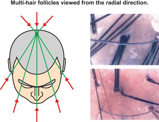 The majority of multi-hair follicles looked oblique when patients were viewed from the front toward the back in the antero-posterior direction (original magnification 100).