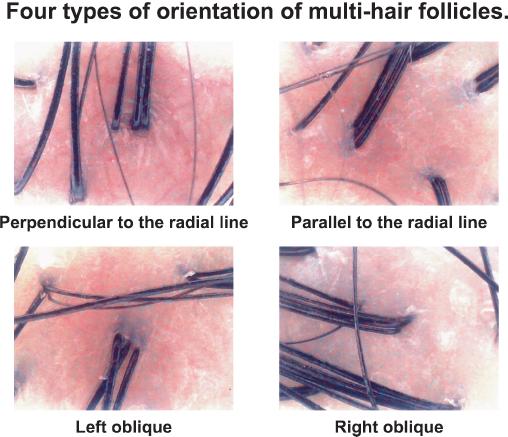 05 were considered to be significant. Results Figure 3. Examined 22 points in the whole scalp. Natural hair follicles were examined in the eight areas of the scalp.
