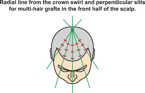 The majority of follicles were oriented perpendicular to the radial line. There was no difference in the dominance of the right or left oblique orientation between Figures 9 and 10.