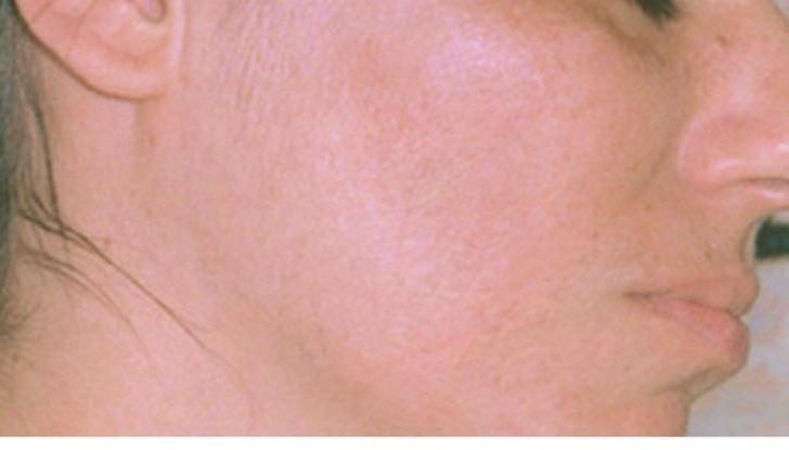 appearance of fine lines and wrinkles around the eyes. Caci Jowl Lift 30mins 30.