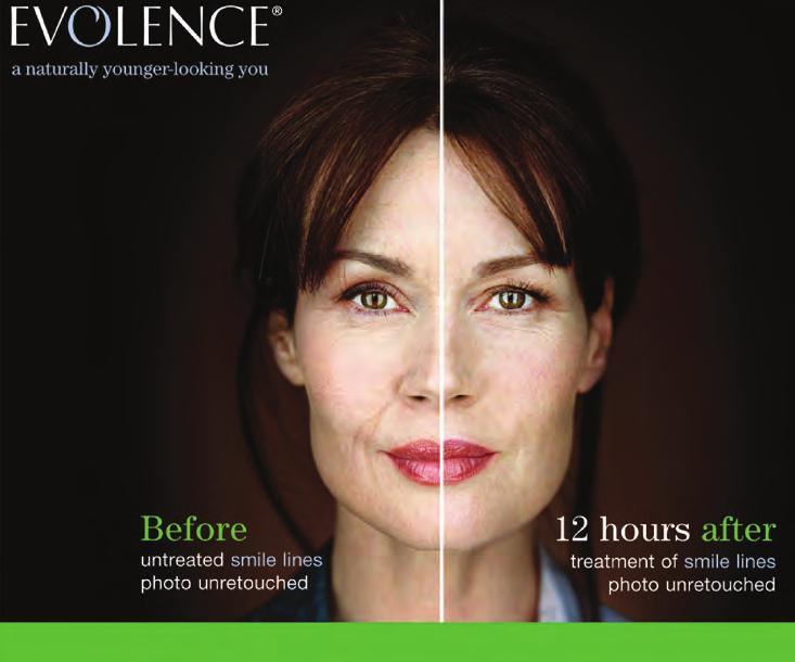 Evolence : Collagen is Back! It is not surprising to learn that the very first dermal filler introduced in the early 1980 s was collagen based.