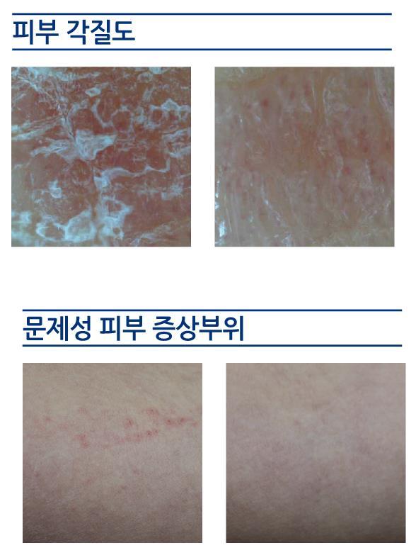 03. DOCTORS PGA Products Clinical Test of γ-pga DOCTORS PGA FOR YOUR SKIN Visual evaluation by atopy diagnostic criteria/