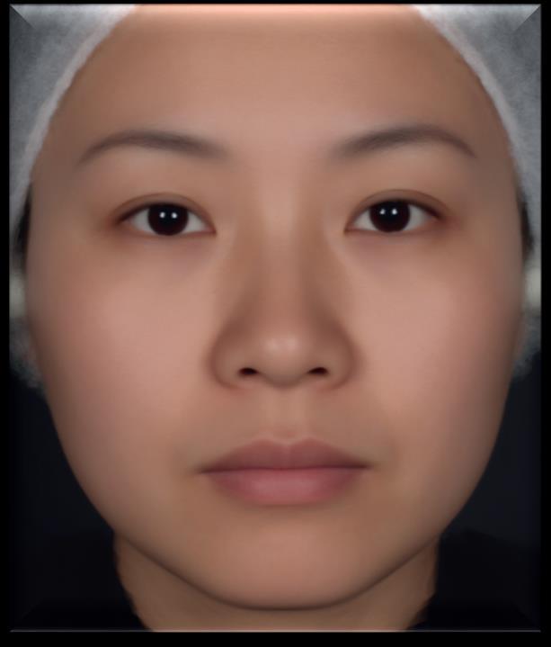 Results Normal BMI Width of Chinese and Caucasian Faces Bellow eyes (125.5 mm) Cheek (121.7 mm) Corner of the mouth (106 mm) Mouth (47 mm) Bellow mouth (85.