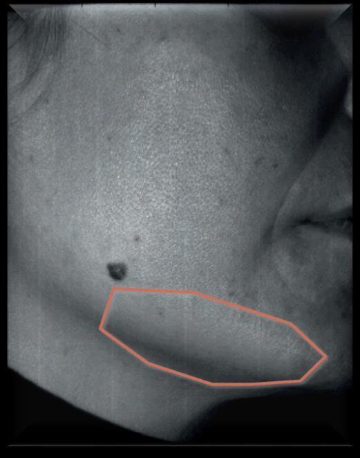 Volume (mm 3 ) Results Maxillary area of the face in the Chinese and the French group Normal BMI 9000 8000 7000 6000 5000 4000 3000 2000 1000 0 + 35,9%