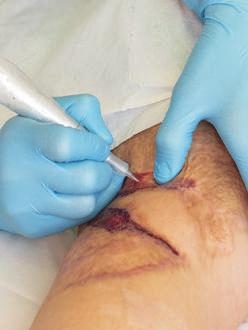 pigmentation, LD and tram scar flattening and pigmention, skin graft and vitiligo