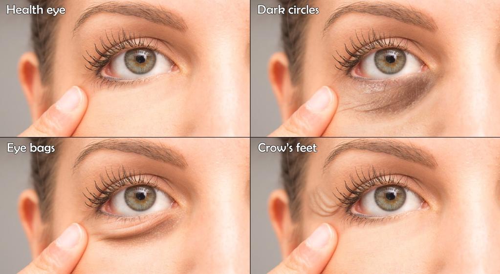 Treatment Plans Eye Concerns Tired Eyes, Crow s Feet, Crepey Skin, Dark Circles, Droopy/Hooded Lids Solutions can include: Upper Face Ultherapy $1,175.00 Brow lift Ultherapy $700.