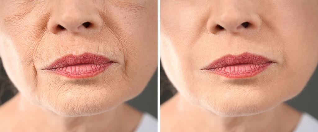 Lip, Mouth and Smile Concerns Thin Lips, Smoker s Lines, Smile Lines, Laugh Lines, Decreased Elasticity