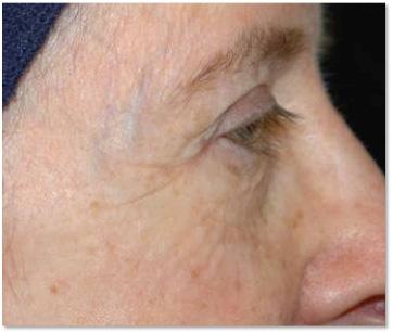 The Holistic Scarless Rejuvenation of the Face 199 reaction that would dissuade the patient from using the product. Start on the lowest and even that levels will still give excellent changes [19].
