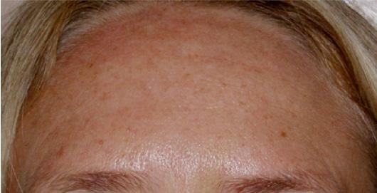 Lower face before needling with 3 mm Roll-CIT Figure 6.