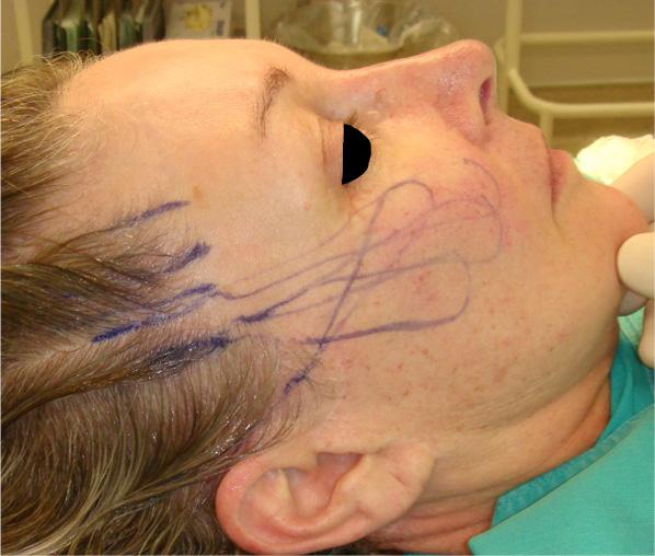 Markings for suture loops of the cheeks.