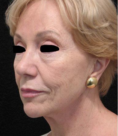 The Holistic Scarless Rejuvenation of the Face 201 Figure 8.