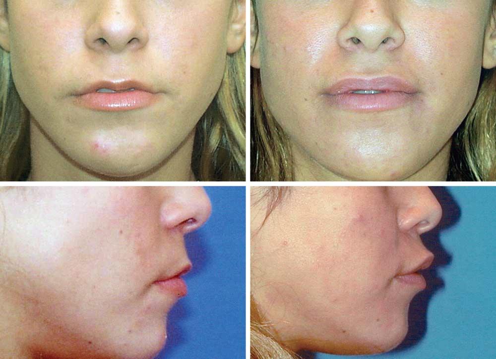 A B C D Figure 7. Preoperative (A and C) and 12-month postoperative (B and D) photographs of patient who underwent upper-lip V-Y lip augmentation. cm; P=.001) and 55.0% (0.25 cm; P=.02), respectively.
