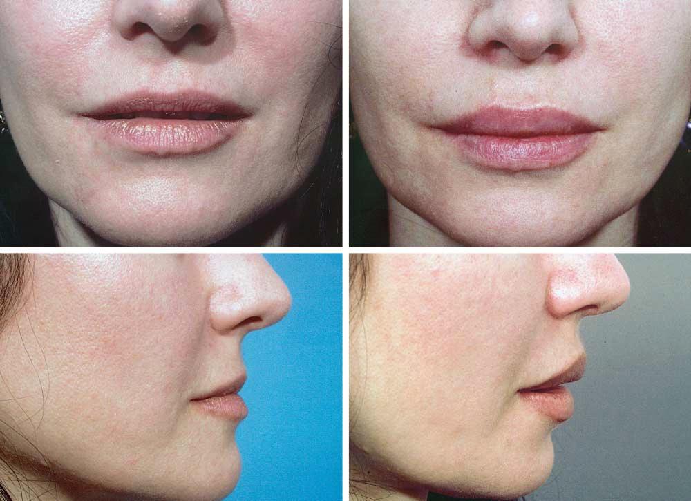 A B C D Figure 8. Preoperative (A and C) and 14-month postoperative (B and D) photographs of patient who underwent upper- and lower-lip V-Y lip augmentation. Table 1.