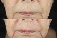 We can also treat areas such as deep upper lip wrinkles that were only partially responsive to older lasers, chemical peels or other therapies. Typically only one treatment is required.