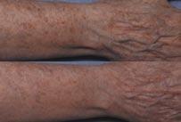 Fraxel Repair CO 2 Laser Skin Resurfacing Hand & Forearm Rejuvenation Until relatively recently treating aging or sun-damaged chests or décolleté and hands or forearms was challenging to obtain nice