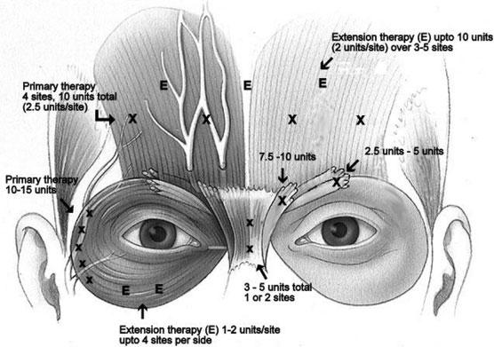 262 FACIAL PLASTIC SURGERY/VOLUME 25, NUMBER 4 2009 Figure 1 Anatomy of upper face demonstrating recommended injection sites and dosages for Botex cosmetics.