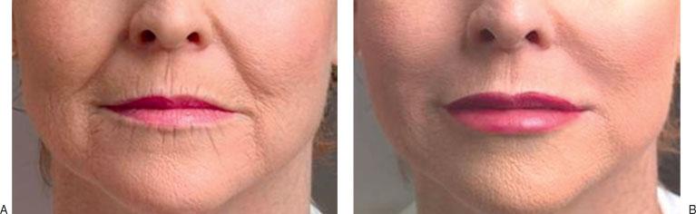MINIMALLY INVASIVE OFFICE TECHNIQUES/MAAS, BAPNA 267 Figure 5 (A) Before and (B) after photos of nasolabial folds injected with Restylane.