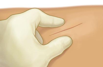 STEP ONE: Clean and dry the wound thoroughly Check the wound and periphery for foreign bodies Ensure hemostasis has been achieved and the wound edges appose readily Remove the applicator from package