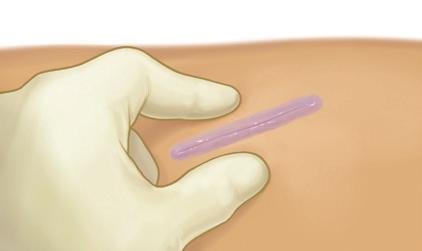 STEP THREE: After cracking the ampoule, tilt the tip of the applicator downward Give the wings a few gentle pumps until the applicator tip turns violet The device is now ready to use STEP SIX: