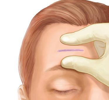 adjust the patient s position. Use petroleum jelly to create a barrier close to the wound, and use surgical gauze to protect patient s eyes.