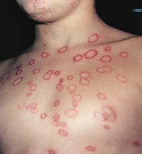 tonsurans Skin-to-skin transmission (head, neck, arms), not matto-skin Excluded from competition if lesions on exposed skin Tinea Corporis/Tinea