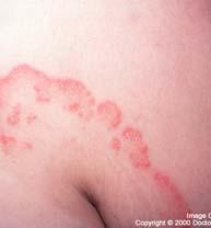 Tinea Incognito Results from improper treatment of a tinea infection May have varied