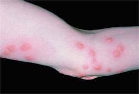 pattern Topical steroids Antihistamines Remove infestation