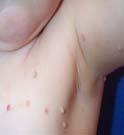 Frequently seen on the face, neck, arm pits, groin, arms and hands MOLLUSCUM Can have associated dermatitis from scratching and inflammation.