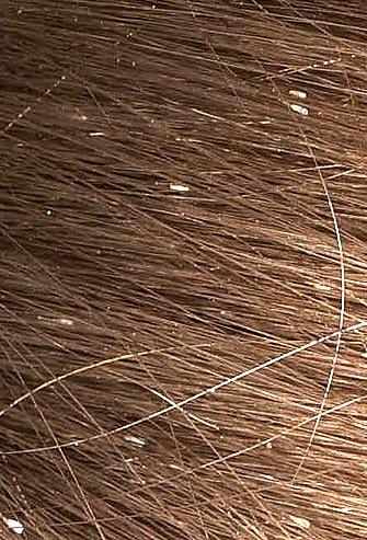AT-HOME LICE CHECK! Remember: Nits will be firmly attached to the hair shaft. You will not be able to blow it away or pull it away with your fingers.