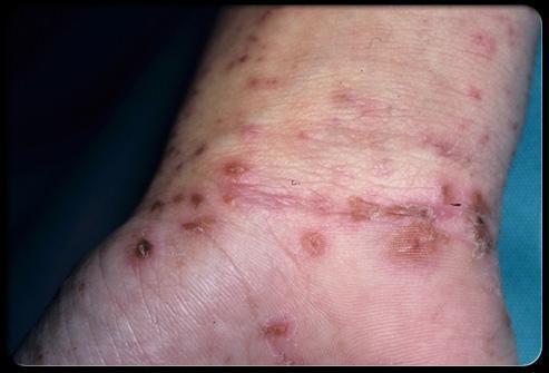 more than 10-15 live mites even if there are hundreds of bumps and pimples on the skin.