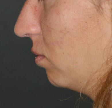 The aging platysma tends to shorten and thin leading to cosmetic deformities including banding
