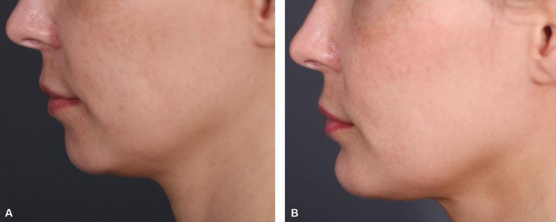 486 Lower Face and Neck Correction Frisenda, Nassif the fenestra toward the skin to create a raw subcutaneous surface for enhanced skin tightening postoperatively.