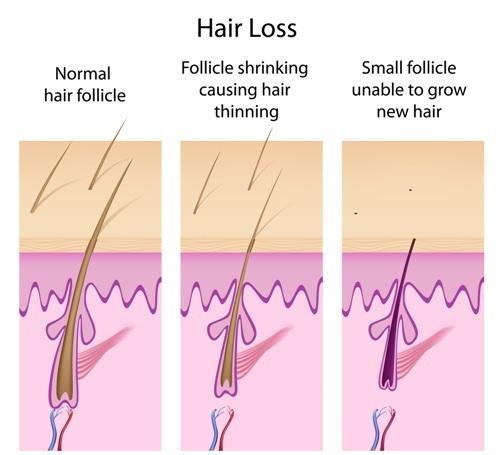 Types of Hair Loss Androgenic Alopecia Pattern Balding or Androgenic Alopecia is caused by hormones. In men, testosterone breaks into its derivative structure called dihydrotestosterone.