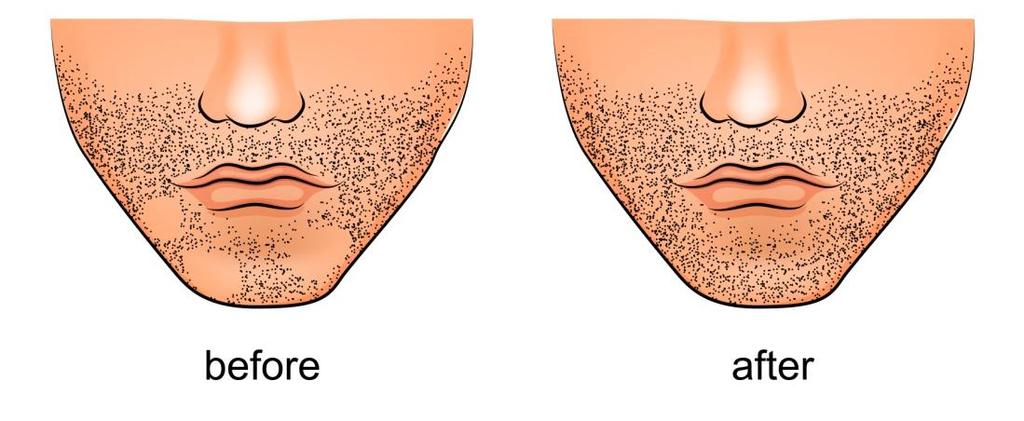 Types of Hair Loss Alopecia Barbae Alopecia Barbae occurs on the facial area such as the beard and mustache.
