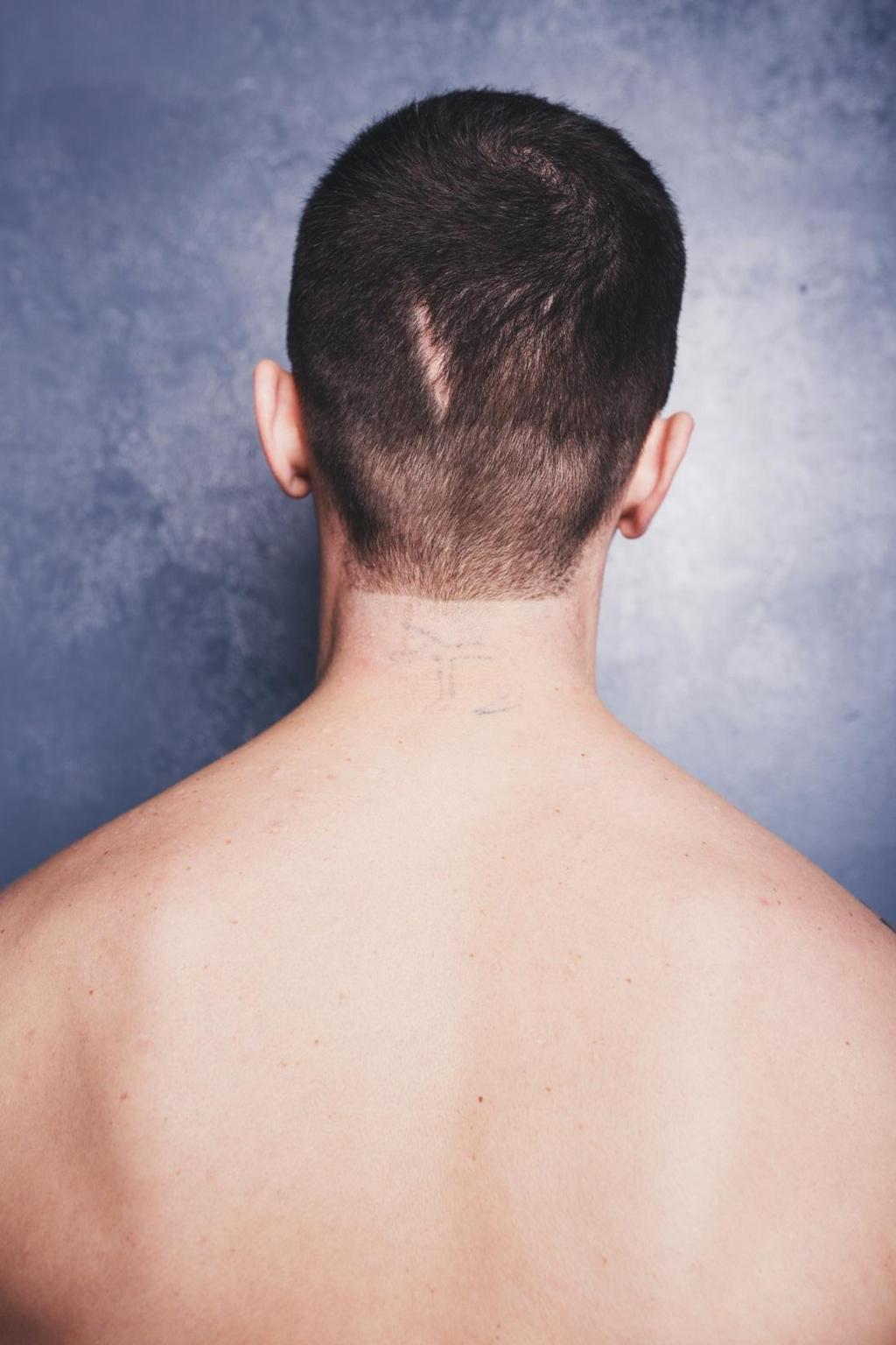 Types of Hair Loss Ciatrical Alopecia Ciatrical Alopecia is known as the scarring alopecia. When permanent scarring occurs, the hair will not experience any growth in the region.