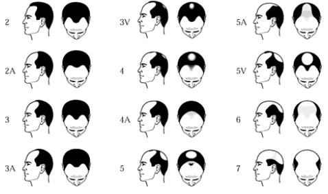 Where Are You now? Male-pattern hair loss can be broken into six classes, Norwood 1-6. Norwood 1 patients generally have a little temporal thinning and temporal recession.