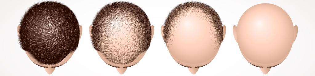 Intro SpaMedica Toronto has prepared this Guide for future and existing patients to gain insight into Hair Transplantation and FUE (Follicular Unit Extraction).