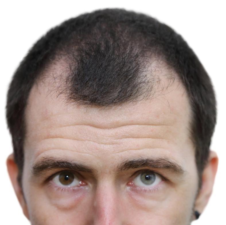 Hair Transplant Aesthetics In addition to the technical skill required to perform hair transplants, an artistic eye is needed.