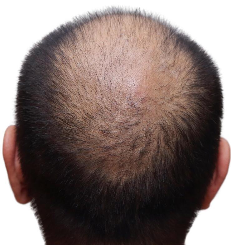 Hair Transplant Aesthetics Most Asian hair is black, coarse and straight, making this hair type the most difficult, especially when the skin is fair. Very small grafts seem to work best.