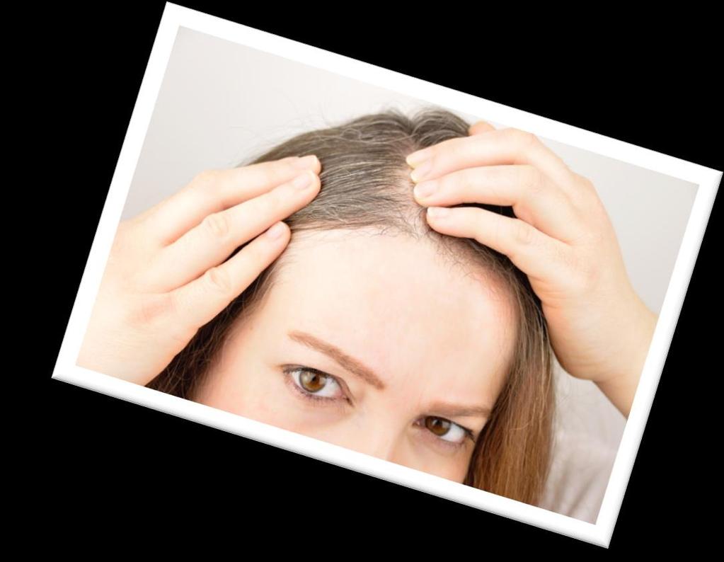 Female Hair Loss Female-pattern hair loss generally does not progress to full-scalp baldness, but, rather a