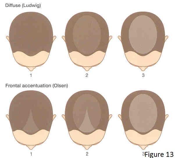 Female Hair Loss Female Hair Loss Female hair loss occurs due to a variety of reasons: genetics, hormonal, environment and medical conditions.