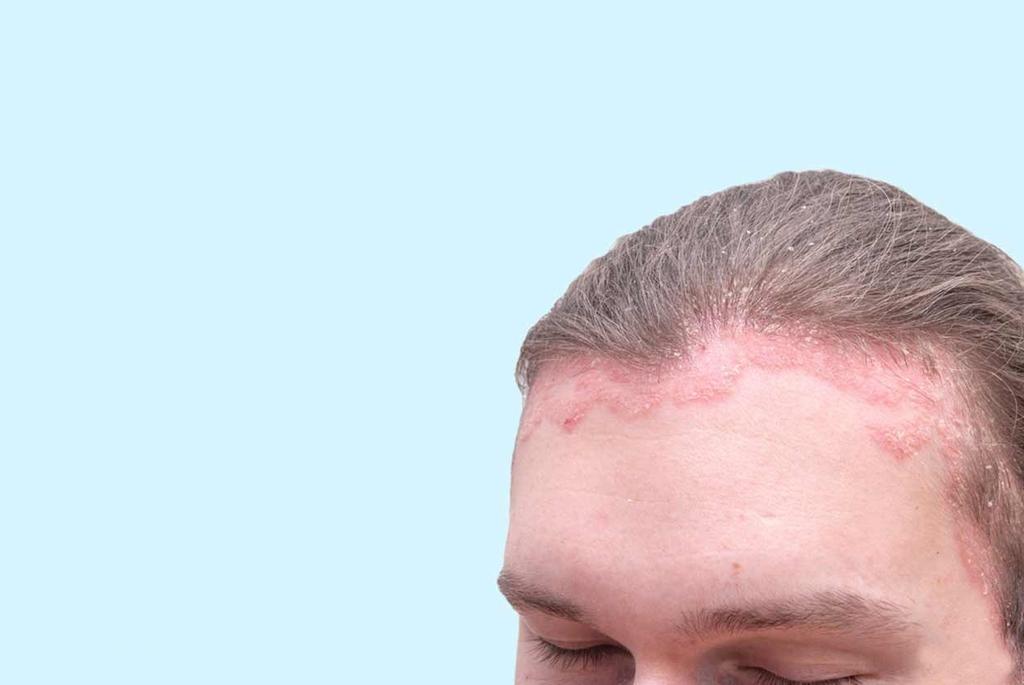 SCALP PEELING FOR DANDRUFF Magnificence frequently is a tedious procedure; to be exact, it requires the steady and legitimate care, normal visits to the beautician, nourishment, wellness and expert