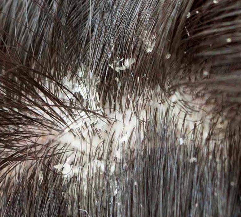 CAUSES OF FUNGAL GROWTH DANDRUFF The causes of Fungal growth Dandruff is due to the